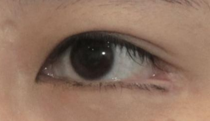 開內(nèi)眼角都會回縮嗎？