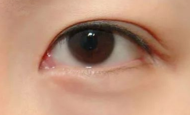 開內眼角的優(yōu)缺點有哪些？