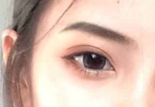 開內外眼角有什么壞處？