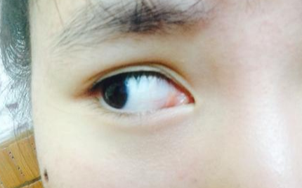 開內(nèi)眼角風險有多大？