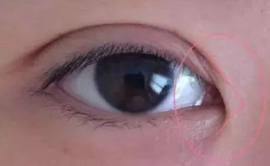 開內(nèi)眼角的作用有哪些？開內(nèi)眼角都會(huì)回縮嗎？