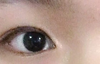 開內眼角的危害有哪些？