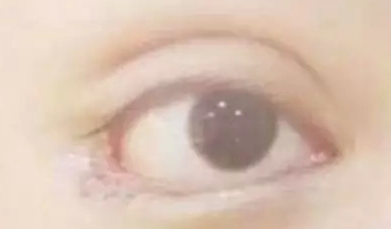 開(kāi)內(nèi)眼角的效果好嗎？