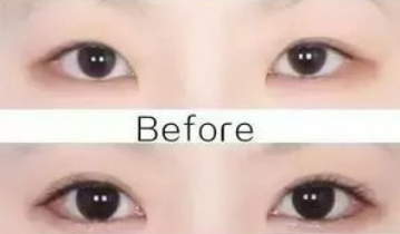 開眼角的危害大嗎？