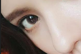 開(kāi)眼角有害嗎？開(kāi)眼角有疤痕嗎？