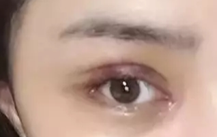 開(kāi)眼角一般要恢復(fù)多久？開(kāi)眼角一定會(huì)出現(xiàn)疤痕嗎？