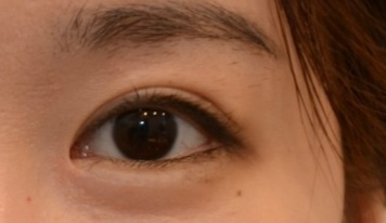 開眼角有效果嗎？開眼角有哪些危害？