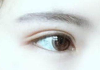 開眼角有幾種方法?開眼角有后遺癥嗎？