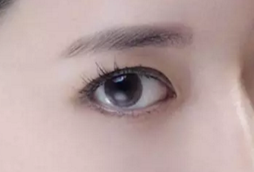 開眼角術(shù)后多久才能恢復(fù)？開眼角術(shù)后防止疤痕增生怎么做？