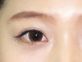 開(kāi)眼角手術(shù)有哪些適應(yīng)人群呢？開(kāi)眼角手術(shù)有哪些特點(diǎn)？