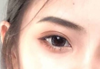 開眼角手術(shù)怎么樣？開眼角手術(shù)怎么做？