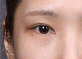 開(kāi)眼角的術(shù)后護(hù)理方法有哪些？