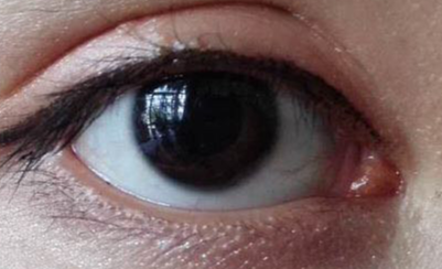 做完開眼角疼不疼？
