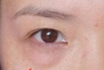 光纖溶脂去眼袋手術(shù)有哪些優(yōu)勢(shì)？