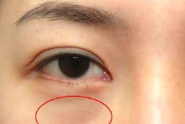光纖溶脂祛眼袋需要多少錢？光纖溶脂怎么樣呢？