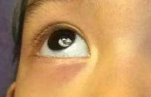 激光祛眼袋需要多少錢？
