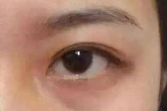 激光祛眼袋有哪些副作用？