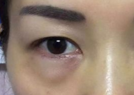 激光可以祛眼袋嗎？激光祛眼袋有哪些副作用？