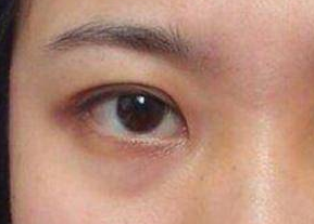 去眼袋是激光好還是內(nèi)切好？激光祛眼袋是什么原理？
