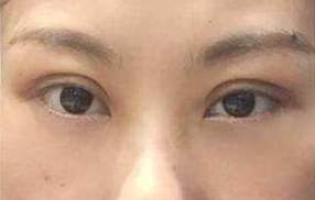 激光祛除眼袋的手術效果好嗎？