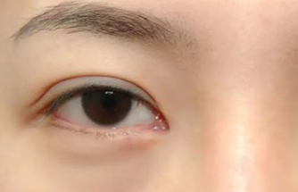 激光去眼袋多久做一次？