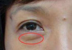 激光去眼袋可以管多久？激光祛眼袋多久可以恢復(fù)？
