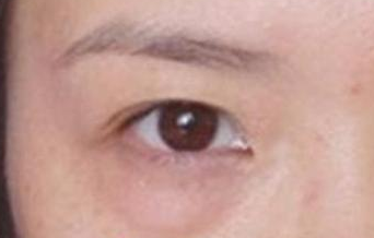 激光去除眼袋后遺癥有哪些？