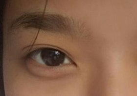 激光去眼袋后需多久能恢復？激光去眼袋快速有效嗎？