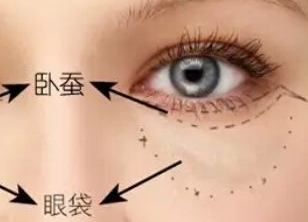 激光去眼袋多久才能恢復(fù)？激光去眼袋有什么副作用嗎？