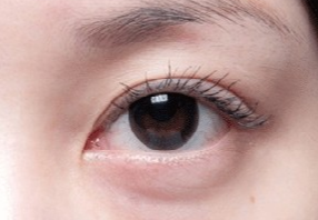激光去眼袋會不會很疼？激光去眼袋什么人適合？