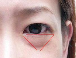 激光除眼袋效果如何？激光去眼袋要注意什么？