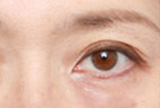 激光去眼袋幾天能恢復(fù)？激光去眼袋是怎樣的？