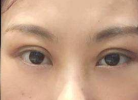 激光去眼袋可保持多久？激光去除眼袋效果好不好？