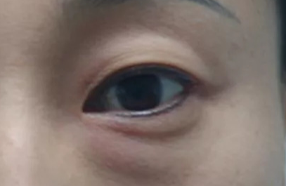 激光去除眼袋效果好不好？