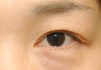 激光去眼袋術(shù)后會(huì)不會(huì)反彈？