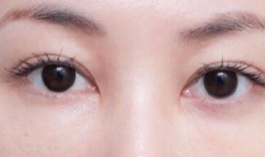 激光去眼袋術(shù)后注意事項(xiàng)有哪些？
