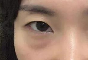 激光去眼袋有什么危害？激光去眼袋幾天能消腫？