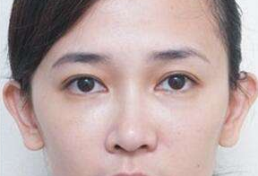 激光去眼袋后要休息多久呢？激光去眼袋會很痛嗎？