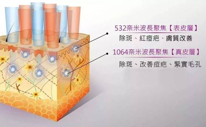 皮秒祛斑恢復(fù)期多久？