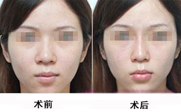 鼻頭縮小手術是怎么做的？術后應該怎么護理