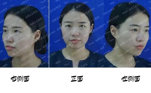 福州名韓整形改善蒜頭鼻大概要花多少錢？