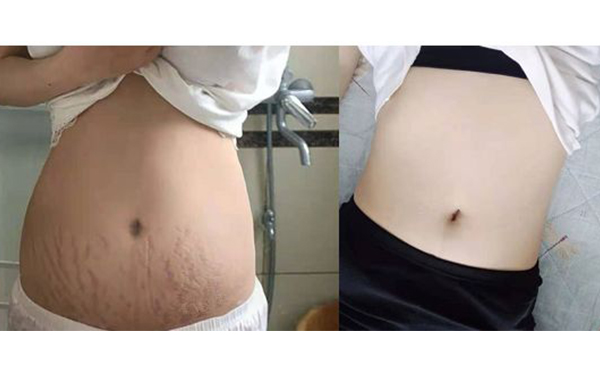 激光可以去除妊娠紋嗎？