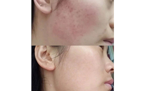 彩光嫩膚會(huì)讓皮膚變薄嗎？