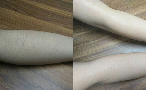 冰點手臂脫毛會傷害皮膚嗎？