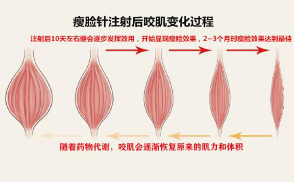 打瘦臉針打多少單位？