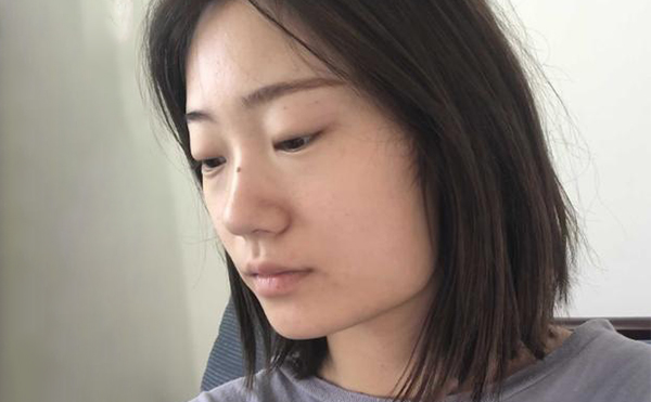 下頜角整形適宜人群有哪些？