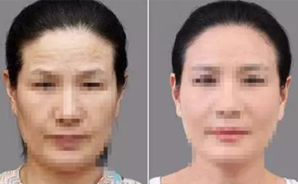 激光除皺有什么優(yōu)勢(shì)？