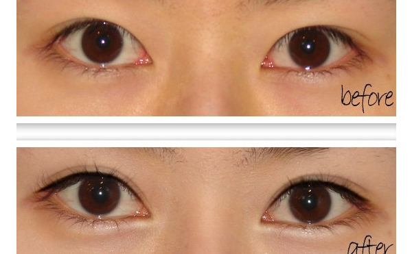 開眼角手術(shù)有什么原則？