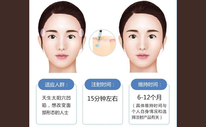 玻尿酸豐太陽穴一般幾支？