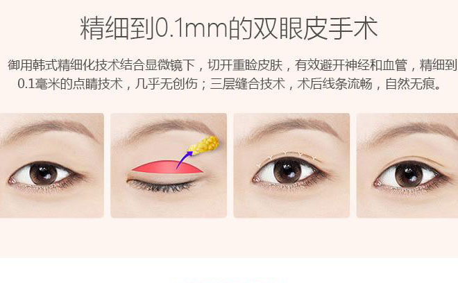 韓式三點(diǎn)雙眼皮一般要多少錢？